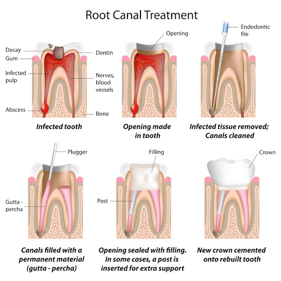 Biomimetic Dentistry Prevents Unnecessary Root Canals