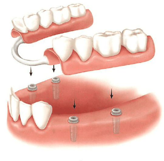 WHY SHOULD YOU GET PARTIAL DENTURE IMPLANTS?